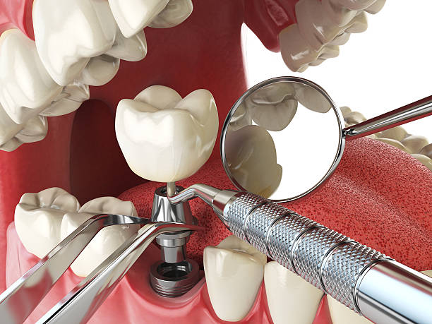 Best Emergency Wisdom Teeth Removal in Stony Point, NC