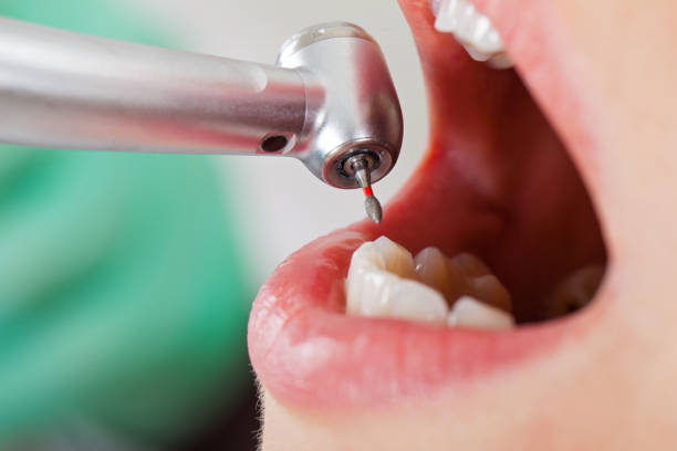 Best Emergency Root Canal Treatment in Stony Point, NC